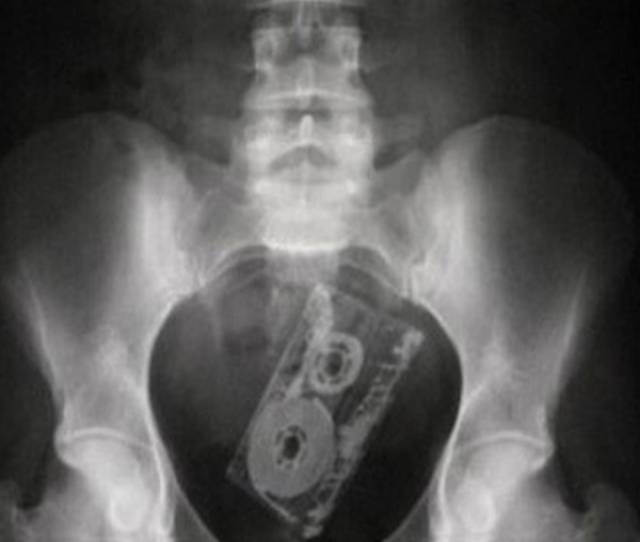 X-Rays That Will Make You Very Uncomfortable