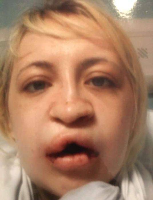 Girl With A Wolf Mouth 10 Operations Later…