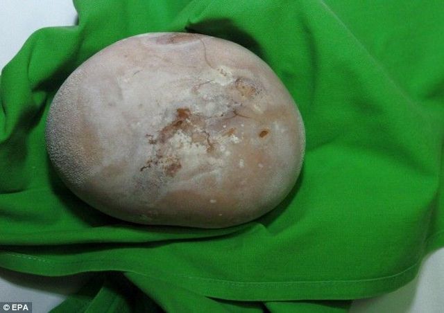 Kidney stone (3 pics)