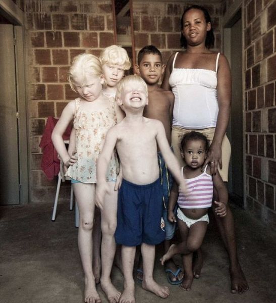Albino Black People. risk numbers of tanzania