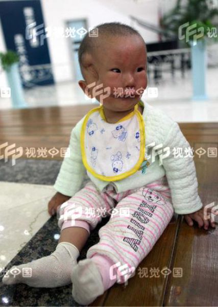 Chinese Boy Born with a Mask-Like Face (5 
pics)
