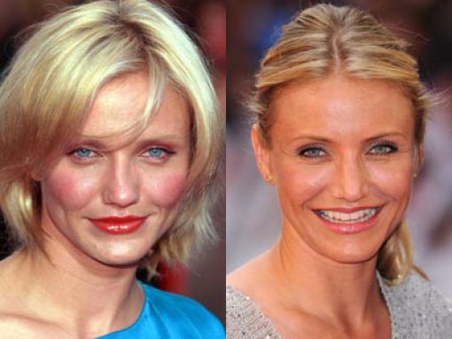 Nose surgery Celebrity Nose Job Before and After