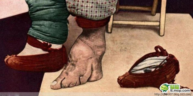 Scary Chinese Tradition Makes Deformed Feet