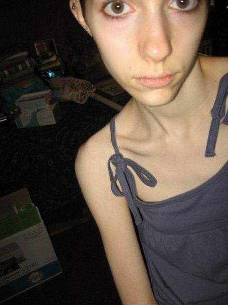 Anorexic Girls 17 Pics Izismile