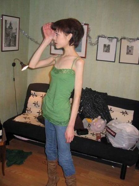 [18sx] Anorexic Girls 17 Pics Peristiwa Dunia Mitos And Sejarah