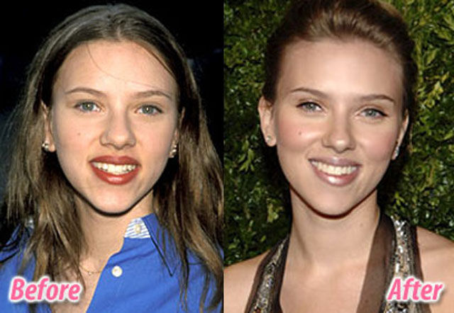 Celebrity Plastic Surgery Before & After