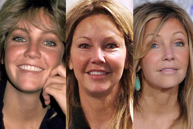 Celebrity Plastic Surgery Before & After