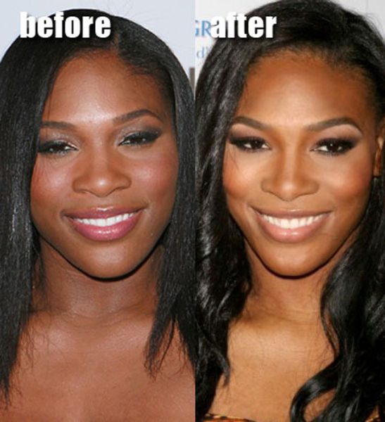 Celebrity Plastic Surgery Before & After