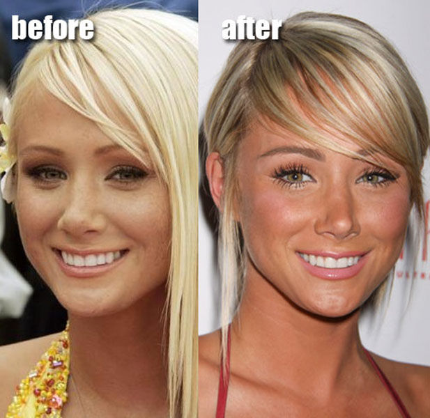 Celebrity Plastic Surgery Before & After (56 pics)