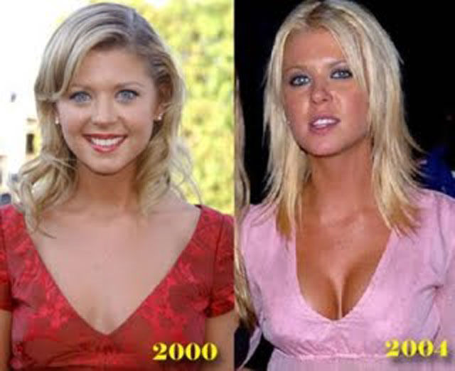 Celebrity Plastic Surgery Before & After (56 pics) - Izismile.com