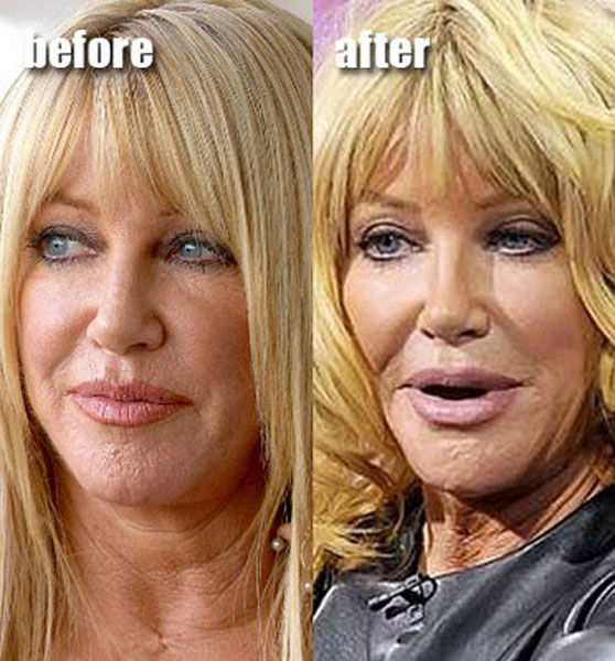 Celebrity Plastic Surgery Before After Pics Izismile Com