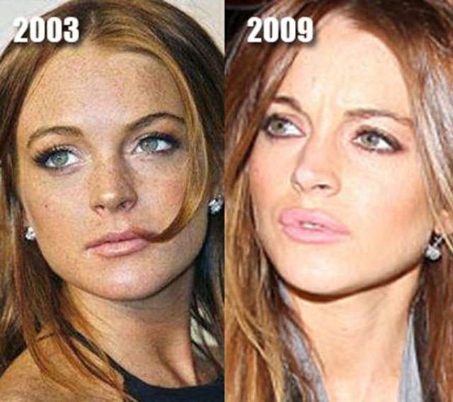 Celebrity Plastic Surgery Before And After 56 Pics Picture 41 