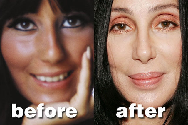 Celebrity Plastic Surgery Before & After