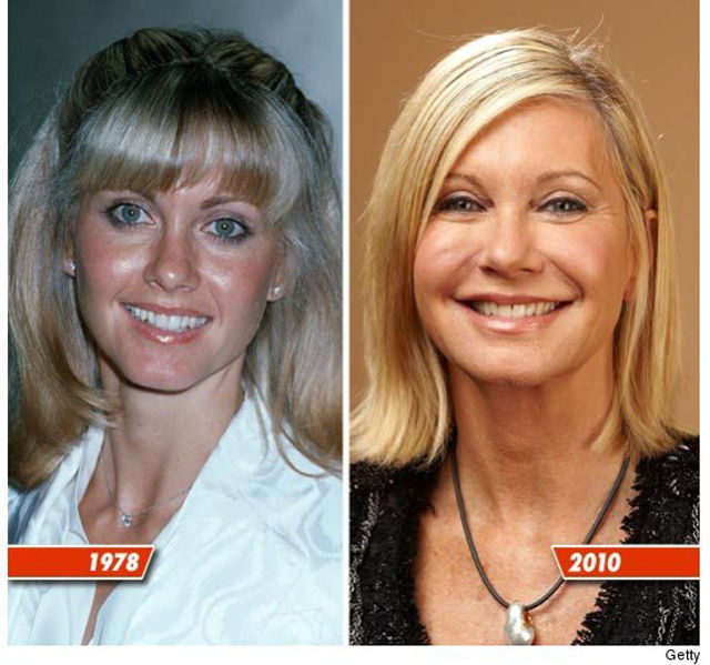 Celebrity Plastic Surgery Before & After