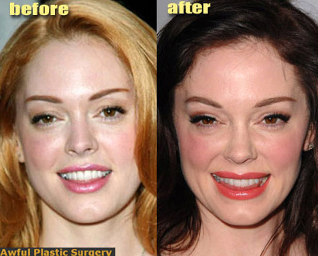 Celebrity Plastic Surgery Before & After