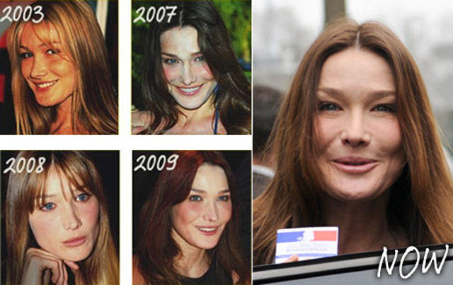 celebs_with_plastic_surgery_640_51.jpg
