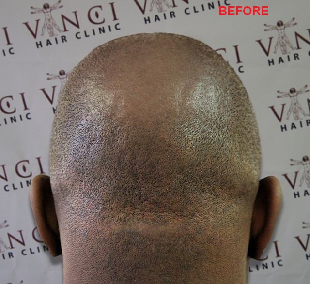 The Best Way to Fight Balding
