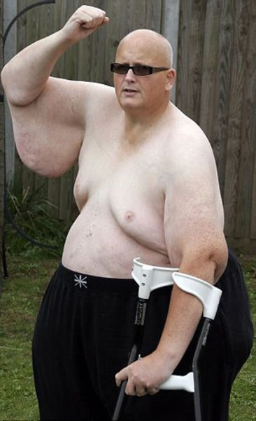 Once The Fattest Man In The World Now Half His Weight Is Gone