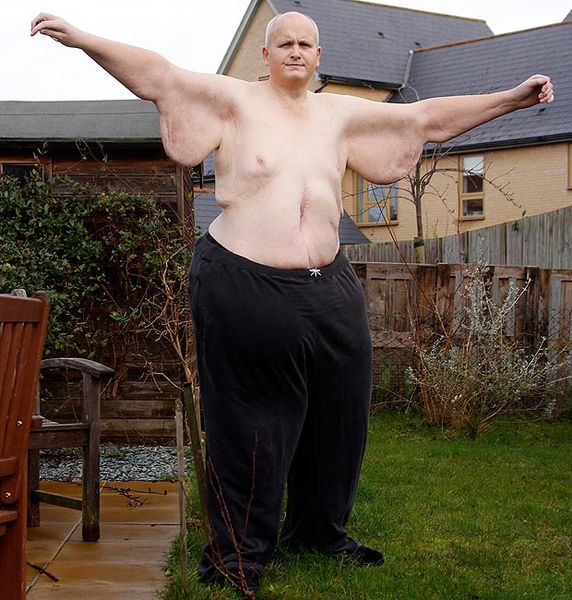 Once The Fattest Man In The World Now Half His Weight Is Gone