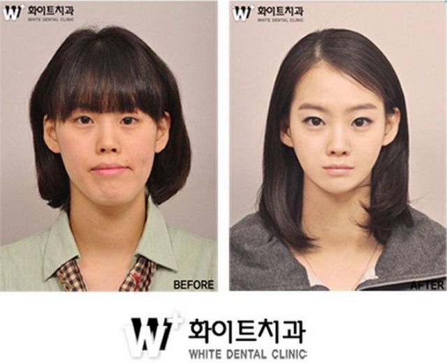 Fun In Your Mind OMG (o_O)!!! Korean Plastic Surgery