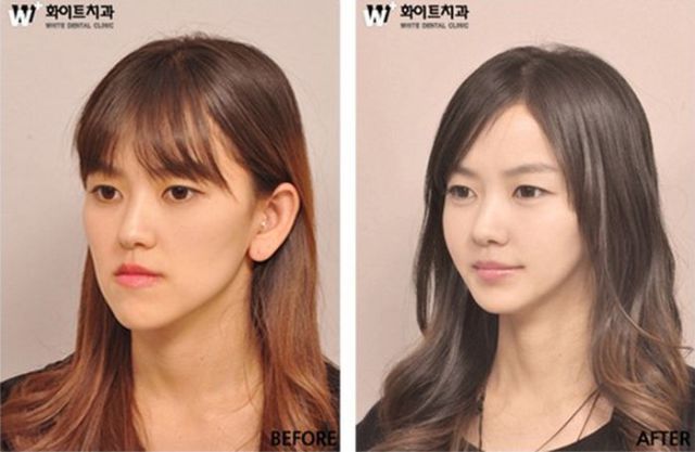 before_and_after_photos_of_korean_plastic_surgery_640_09.jpg