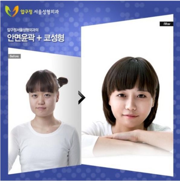 before_and_after_photos_of_korean_plastic_surgery_640_10.jpg