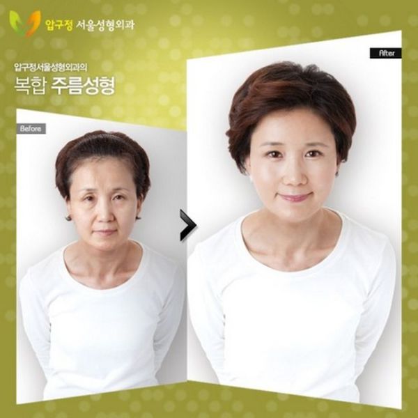 before_and_after_photos_of_korean_plastic_surgery_640_13.jpg