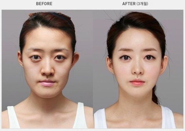 Before And After Photos Of Korean Plastic Surgery 30 Pics Izismile