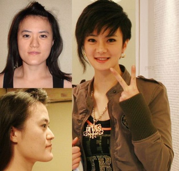 before_and_after_photos_of_korean_plastic_surgery_640_17.jpg