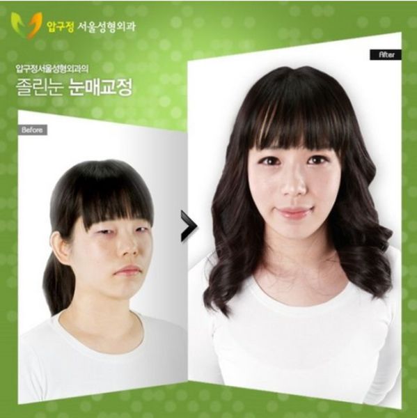 before_and_after_photos_of_korean_plastic_surgery_640_26.jpg