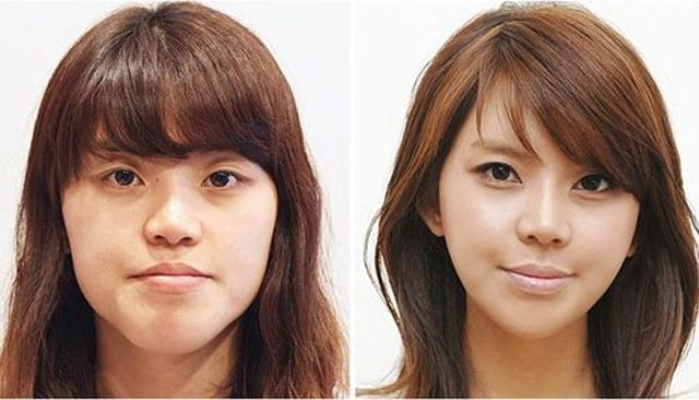 Before And After Photos Of Korean Plastic Surgery Part Pics Izismile