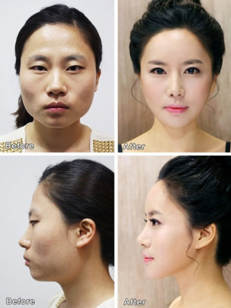 Before and After Photos of Korean Plastic Surgery. Part 2