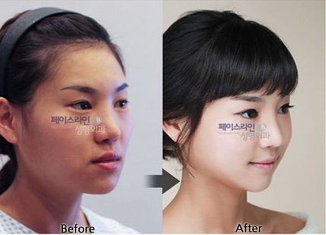 Before and After Photos of Korean Plastic Surgery. Part 2