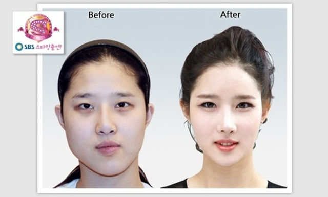 Before And After Photos Of Korean Plastic Surgery Part Pics