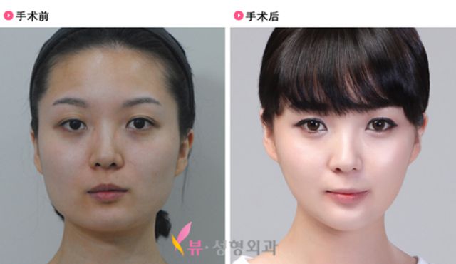 Before and After Photos of Korean Plastic Surgery. Part 2