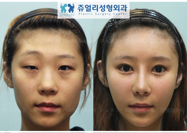 Before and After Photos of Korean Plastic Surgery. Part 2