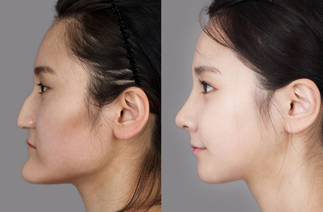 Before and After Photos of Korean Plastic Surgery. Part 2