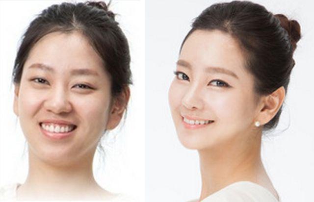 Before And After Photos Of Korean Plastic Surgery Part 2 62 PICS