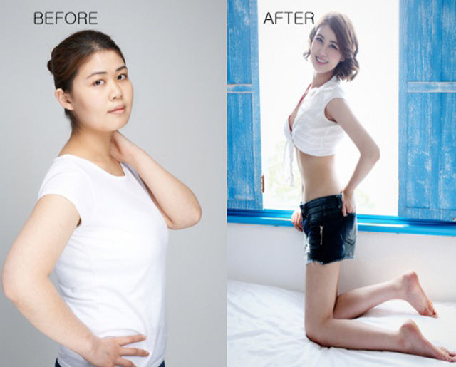 Before and After Photos of Korean Plastic Surgery. Part 2