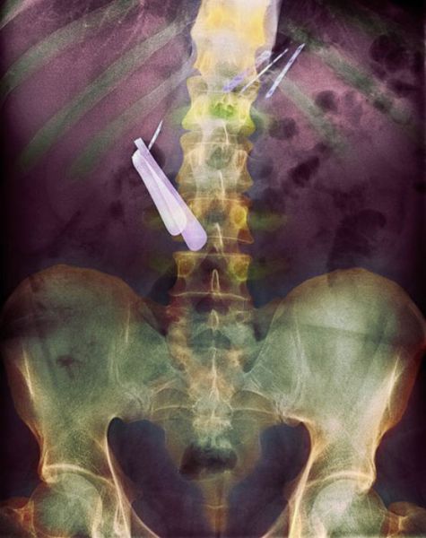 Real X-Rays That Are Will Shock You