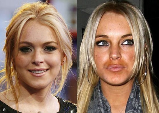 Revealing Photos of Stars Pre and Post Plastic Surgery
