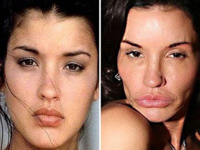 Revealing Photos of Stars Pre and Post Plastic Surgery