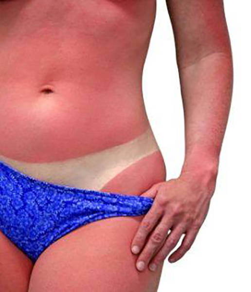 Examples When People Forgot They Can Actually Get Sunburns If They Don Examples When People Forgot They Can Actually Get Sunburns If They Don