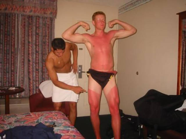 Examples When People Forgot They Can Actually Get Sunburns If They Don Examples When People Forgot They Can Actually Get Sunburns If They Don