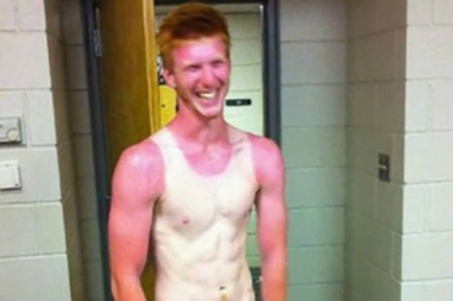 Examples When People Forgot They Can Actually Get Sunburns If They Don Examples When People Forgot They Can Actually Get Sunburns If They Don