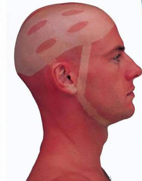 Examples When People Forgot They Can Actually Get Sunburns If They Don Examples When People Forgot They Can Actually Get Sunburns If They Don