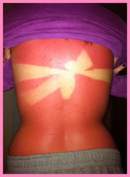 Examples When People Forgot They Can Actually Get Sunburns If They Don Examples When People Forgot They Can Actually Get Sunburns If They Don