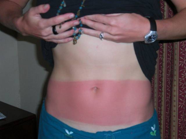 Examples When People Forgot They Can Actually Get Sunburns If They Don Examples When People Forgot They Can Actually Get Sunburns If They Don