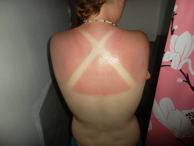 Examples When People Forgot They Can Actually Get Sunburns If They Don Examples When People Forgot They Can Actually Get Sunburns If They Don
