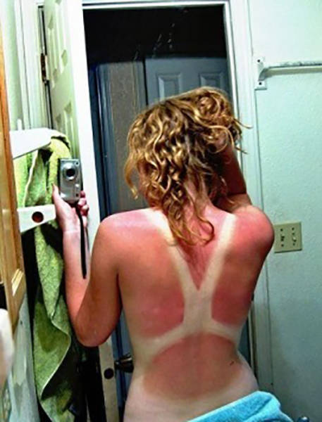 Examples When People Forgot They Can Actually Get Sunburns If They Don Examples When People Forgot They Can Actually Get Sunburns If They Don